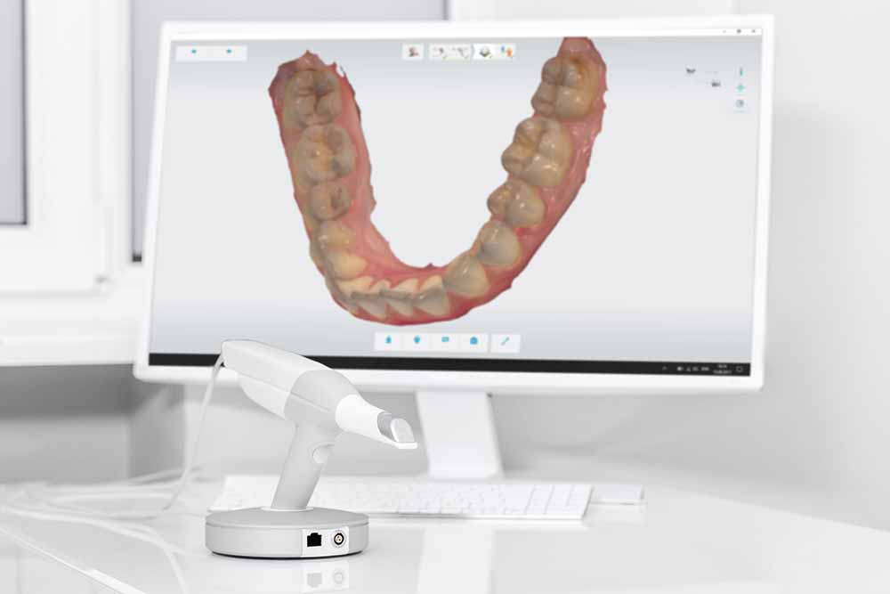 scanner intraorale